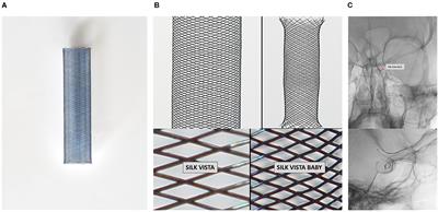 Treatment of Intracranial Aneurysms Using the New Silk Vista Flow Diverter: Safety Outcomes at Short-Term Follow-Up